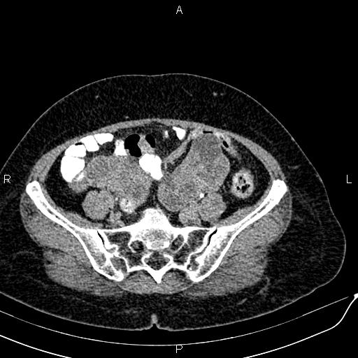 Bilateral ovarian serous cystadenocarcinoma (Radiopaedia 86062-101989 Axial C+ delayed 58).jpg
