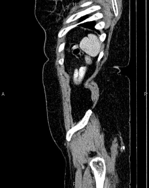 Bilateral ovarian serous cystadenocarcinoma (Radiopaedia 86062-101989 E 81).jpg