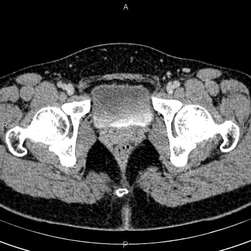 File:Bilateral ovarian teratoma (Radiopaedia 83131-97503 B 72).jpg