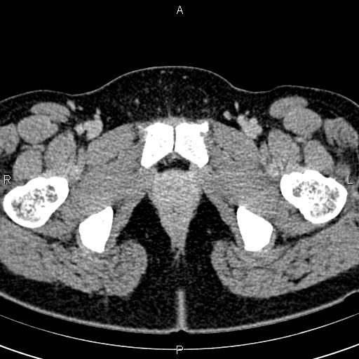 Bilateral ovarian teratoma (Radiopaedia 83131-97503 B 82).jpg
