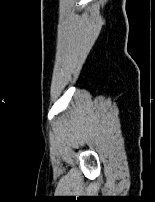 Bilateral ovarian teratoma (Radiopaedia 83131-97503 D 104).jpg