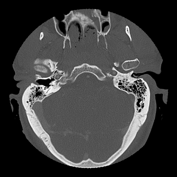 File:Bilateral perched facets with cord injury (Radiopaedia 45587-49713 Axial bone window 9).jpg