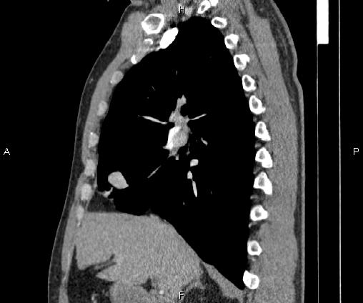 Bilateral pulmonary AVM (Radiopaedia 83134-97505 D 49).jpg