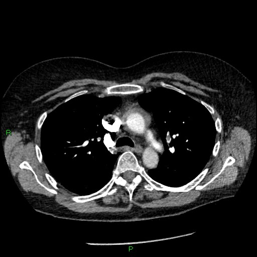 File:Bilateral pulmonary emboli (Radiopaedia 32700-33669 Axial C+ CTPA 38).jpg