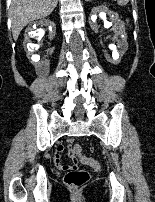 Bilateral staghorn calculi (Radiopaedia 59475-66842 Coronal non-contrast 74).jpg