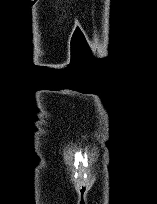 Bilateral staghorn calculi (Radiopaedia 59475-66842 Coronal non-contrast 96).jpg