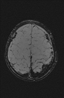 Bilateral subdural hemorrhage and parietal skull fracture (Radiopaedia 26058-26190 Axial SWI 68).png