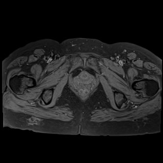 Bilateral tubo-ovarian abscesses (Radiopaedia 58635-65829 Axial T1 fat sat 40).jpg