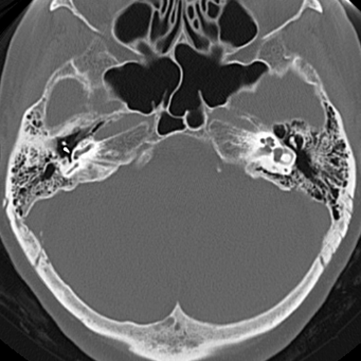 File:Bilateral tympanoplasty (Radiopaedia 16947-16664 Axial bone window 13).jpg