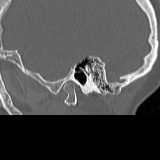 File:Bilateral tympanoplasty (Radiopaedia 16947-16664 Sagittal bone window 14).jpg