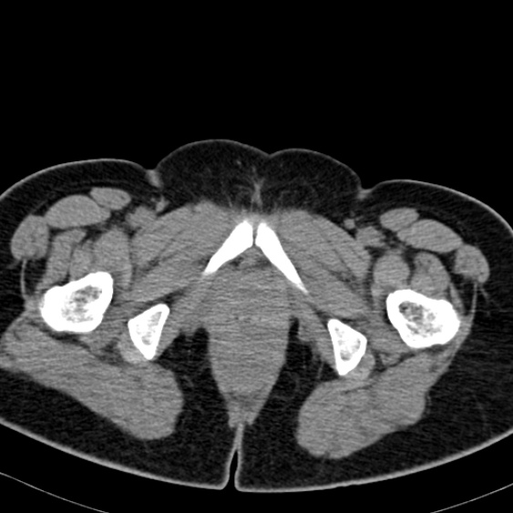 Bilateral ureteric stents (Radiopaedia 48795-53825 Axial non-contrast 72).jpg