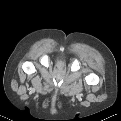 File:Bladder papillary urothelial carcinoma (Radiopaedia 48119-52951 Axial C+ delayed 64).png
