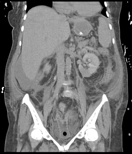 Bladder rupture post renal biopsy (Radiopaedia 30863-31572 Coronal non-contrast 32).jpg
