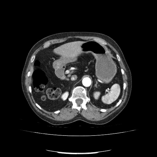 Bladder tumor detected on trauma CT (Radiopaedia 51809-57609 A 89).jpg