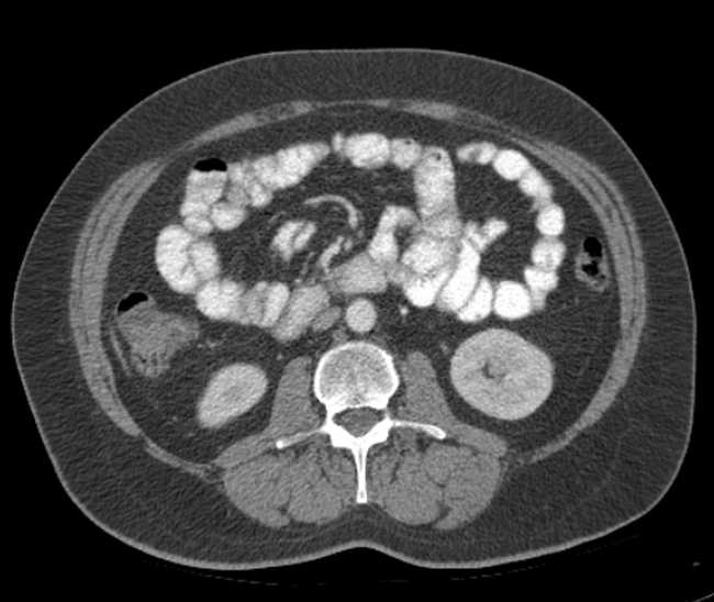 Bleeding duodenal ulcer and adenomyomatosis of gallbladder (Radiopaedia 61834-69861 A 61).jpg