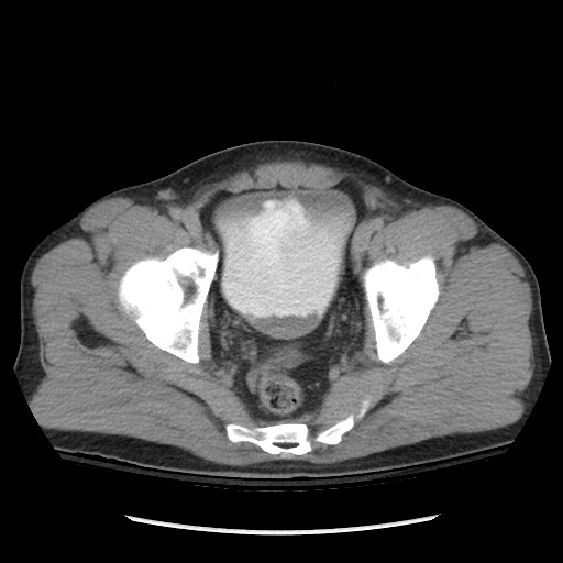 Blunt abdominal trauma with solid organ and musculoskelatal injury with active extravasation (Radiopaedia 68364-77895 Axial C+ delayed 124).jpg