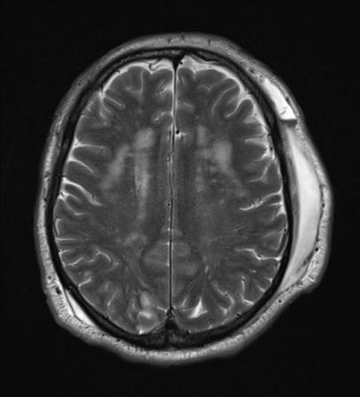 File:Blunt cerebrovascular injury (Radiopaedia 53682-59745 Axial T2 21).png