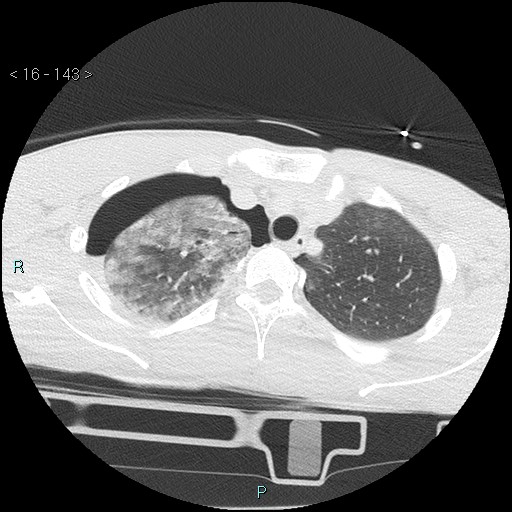 Blunt chest trauma (Swiss cheese sign) (Radiopaedia 38519-40618 Axial lung window 12).jpg