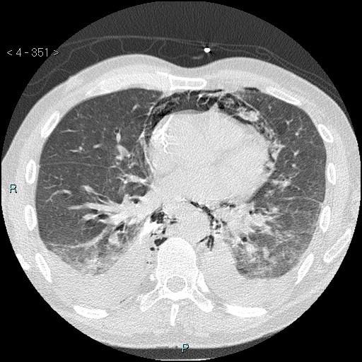 Boerhaave syndrome (Radiopaedia 27683-27897 lung window 51).jpg