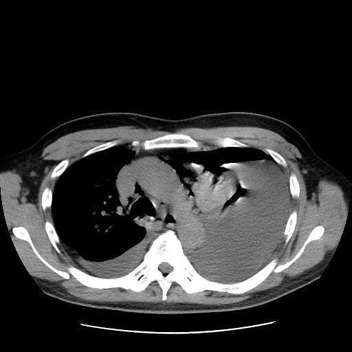 Boerhaave syndrome (Radiopaedia 59796-67310 Axial liver window 24).jpg