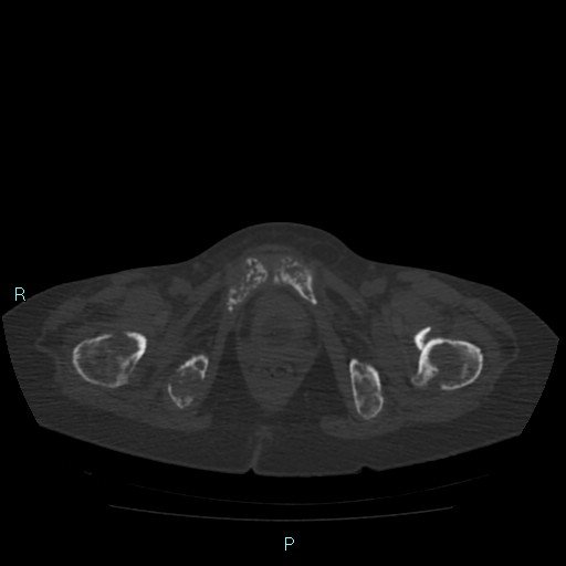 Bone metastases from untreated breast cancer (Radiopaedia 42973-46219 Axial bone window 195).jpg