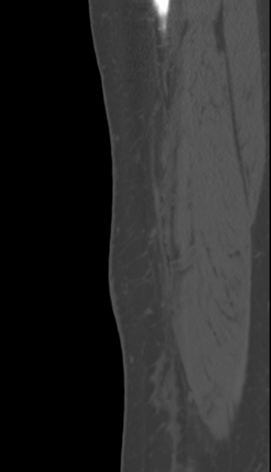 Bone metastasis - tibia (Radiopaedia 57665-64609 Sagittal bone window 23).jpg