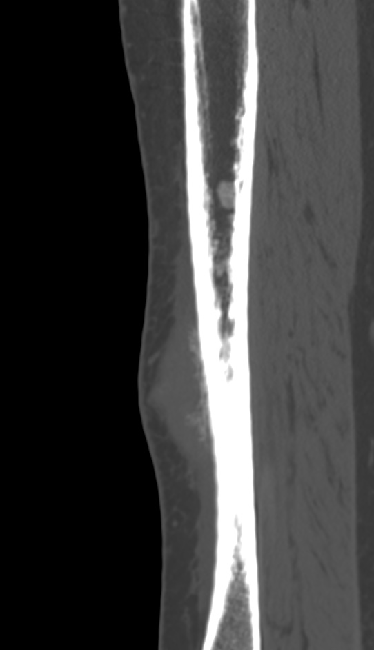 Bone metastasis - tibia (Radiopaedia 57665-64609 Sagittal bone window 55).jpg