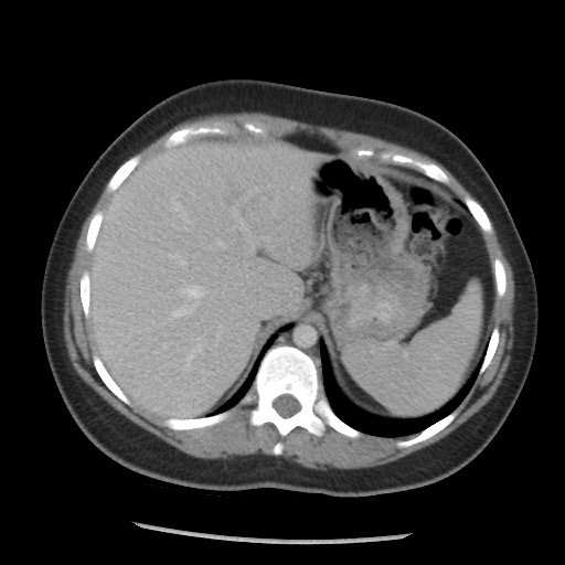 File:Borderline mucinous tumor (ovary) (Radiopaedia 78228-90808 A 70).jpg