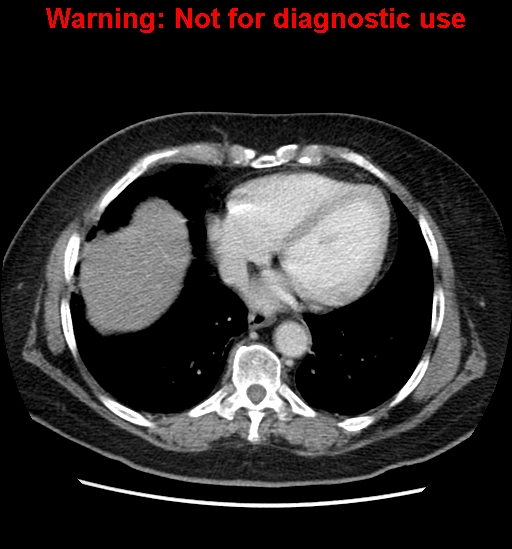 File:Bosniak renal cyst - type II (Radiopaedia 23404-23468 D 7).jpg