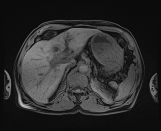 Bouveret syndrome (Radiopaedia 61017-68856 Axial T1 fat sat 24).jpg