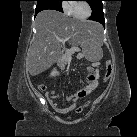 Bowel and splenic infarcts in acute lymphocytic leukemia (Radiopaedia 61055-68913 B 26).jpg