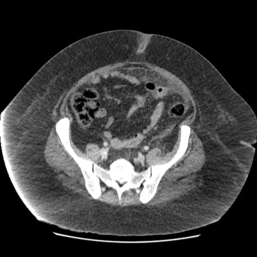 Bowel and splenic infarcts in acute lymphocytic leukemia (Radiopaedia 61055-68915 A 100).jpg