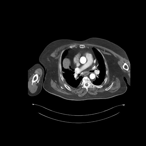 Bowel ischemia secondary to SMA occlusion with extensive portomesenteric venous gas (Radiopaedia 54656-60871 A 82).jpg