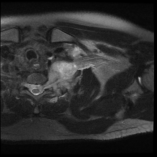 File:Brachial plexus neurofibroma (Radiopaedia 28030-28291 Axial T2 fat sat 9).png