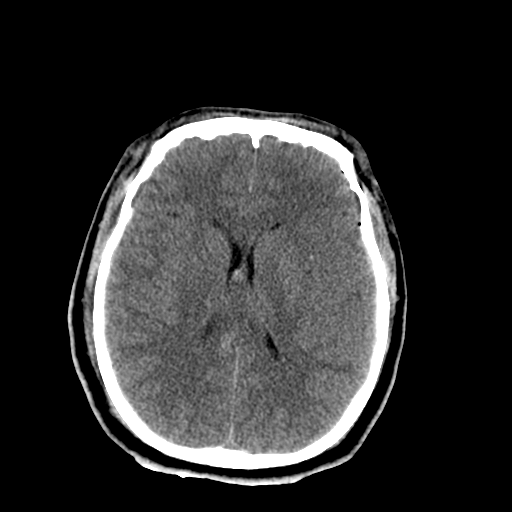 File:Brain contusions, internal carotid artery dissection and base of skull fracture (Radiopaedia 34089-35339 Axial non-contrast 32).png
