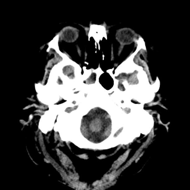Brain cortical laminar necrosis (Radiopaedia 25822-25971 Axial non-contrast 4).jpg