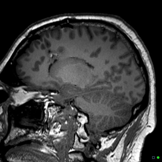 Brain death on MRI and CT angiography (Radiopaedia 42560-45689 Sagittal T1 40).jpg