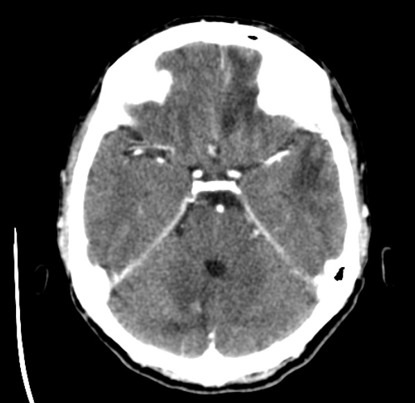File:Brain metastases from lung cancer (Radiopaedia 24480-24781 Axial C+ delayed 17).jpg
