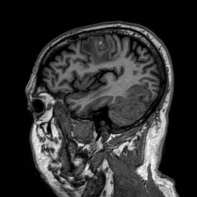 Brain metastases from lung cancer (Radiopaedia 83839-99028 Sagittal T1 101).jpg