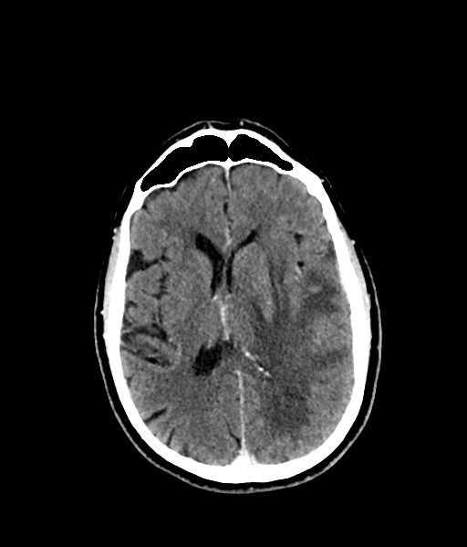 Brain metastasis (large cystic mass) (Radiopaedia 47497-52106 Axial C+ 36).png