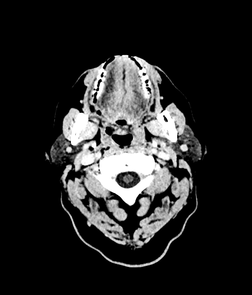 Brain metastasis (large cystic mass) (Radiopaedia 47497-52106 Axial C+ 5).png