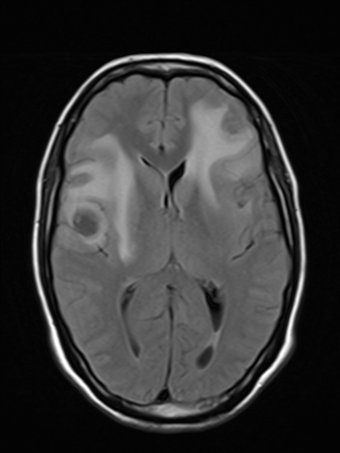 File:Brain metastasis as initial presentation of non-small cell lung cancer (Radiopaedia 65122-74126 Axial FLAIR 11).jpg
