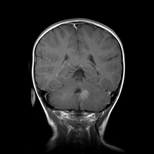 File:Brainstem ganglioglioma (Radiopaedia 10763-11224 Coronal T1 C+ 7).jpg
