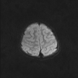 Brainstem glioma (Radiopaedia 67531-76922 Axial DWI 43).jpg