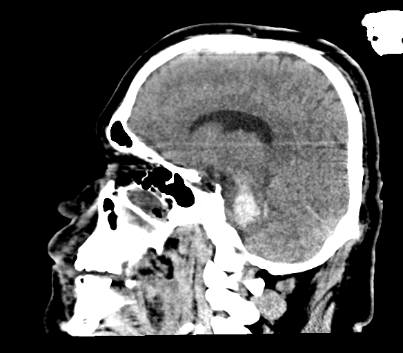 File:Brainstem hemorrhage (Radiopaedia 81294-94976 C 34).jpg
