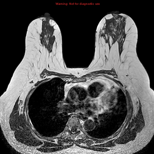 File:Breast carcinoma (multicentric multifocal in mammary Paget disease) (Radiopaedia 50966-56512 Axial T1 9).jpg