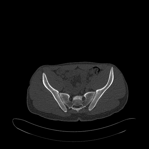 Brodie abscess- femoral neck (Radiopaedia 53862-59966 Axial bone window 63).jpg