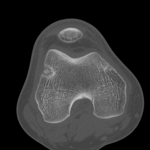 Brodie abscess of the tibia (Radiopaedia 58984-66250 Axial bone window 39).jpg