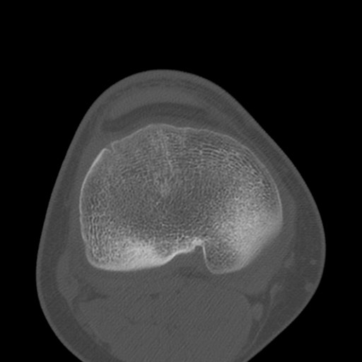 Brodie abscess of the tibia (Radiopaedia 58984-66250 Axial bone window 60).jpg