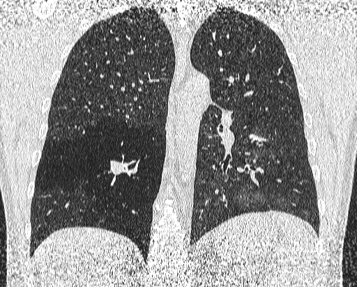 Bronchial atresia (Radiopaedia 58271-65417 Coronal lung window 38).jpg